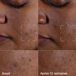 Clinique Sérum></noscript>Even Better Clinical™